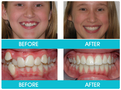 Braces Before and After / Invisible Aligners Before and After